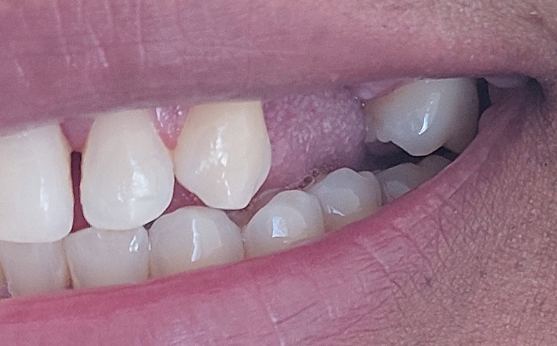 Reposición de dientes en la prótesis