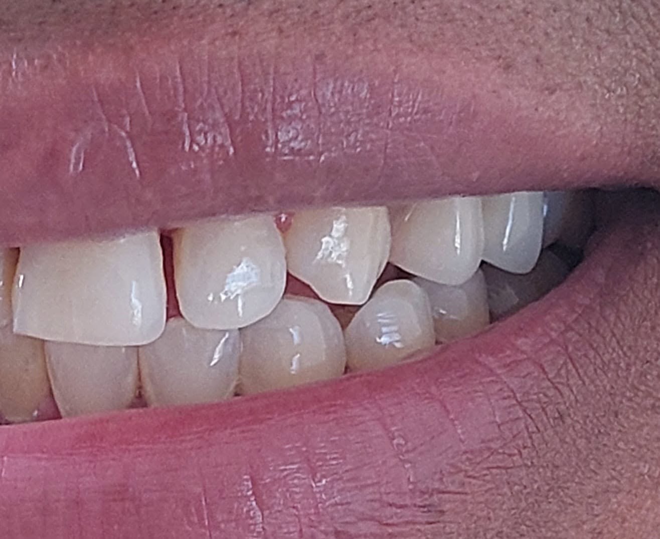 Reposición de dientes en la prótesis