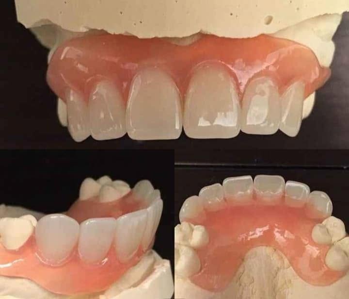 Reparación de prótesis triple